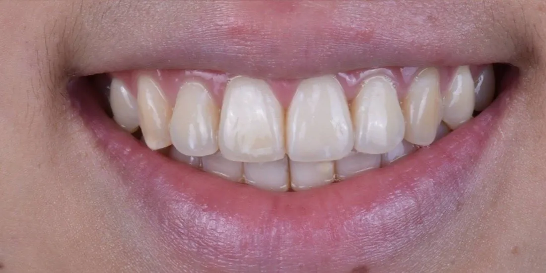 The same patient’s teeth after braces treatment