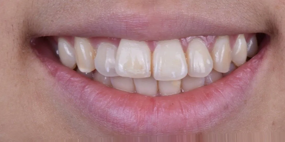 A patient’s teeth before braces treatment