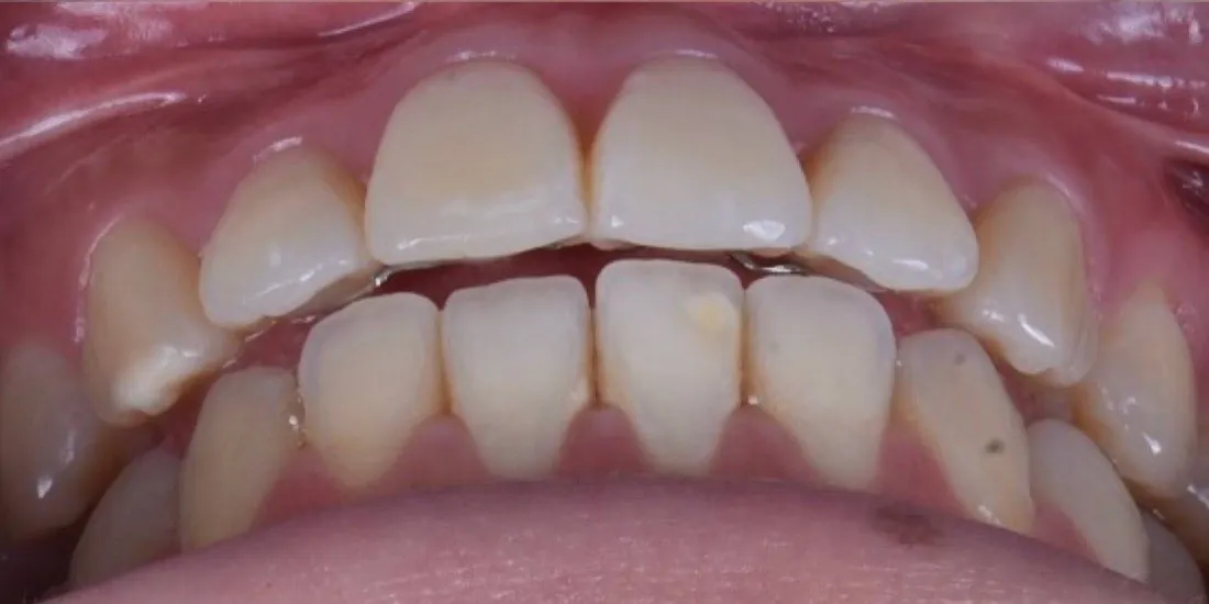 The same patient’s teeth after braces treatment