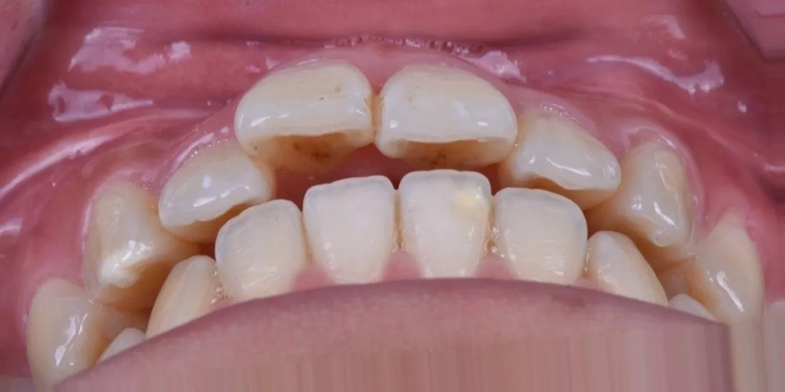 A patient’s teeth before braces treatment
