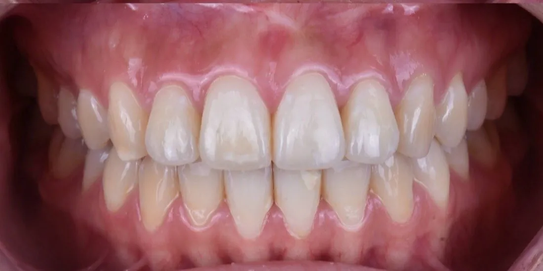 The same patient’s teeth after braces treatment