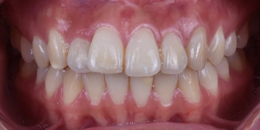 A patient’s teeth before braces treatment