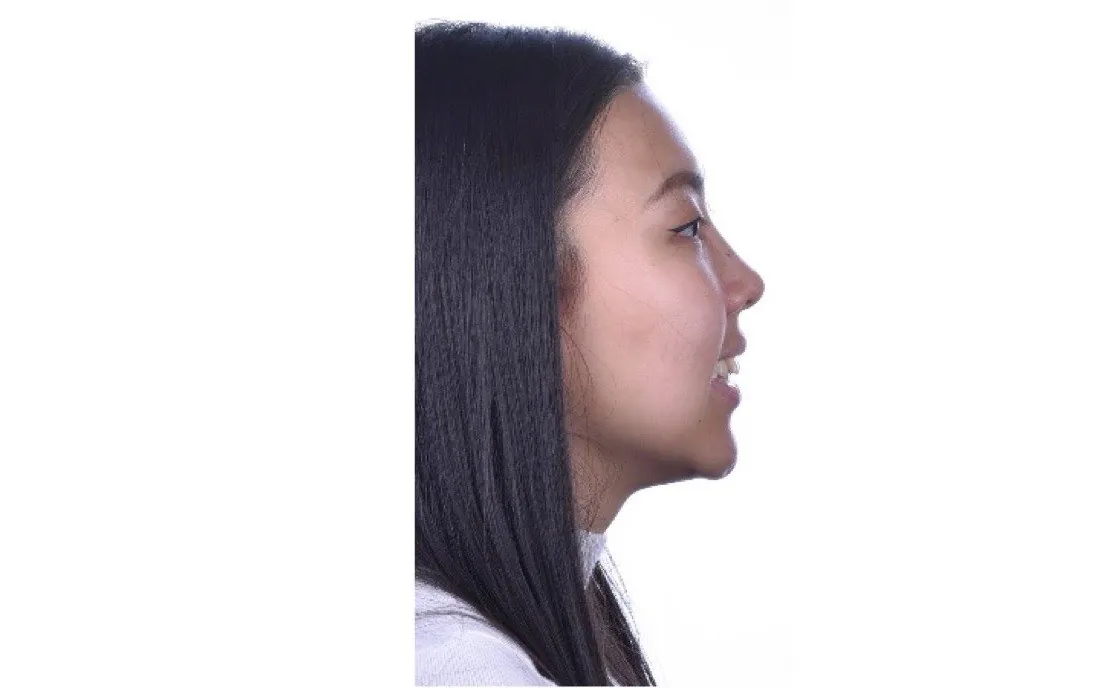 A patient’s teeth before braces treatment
