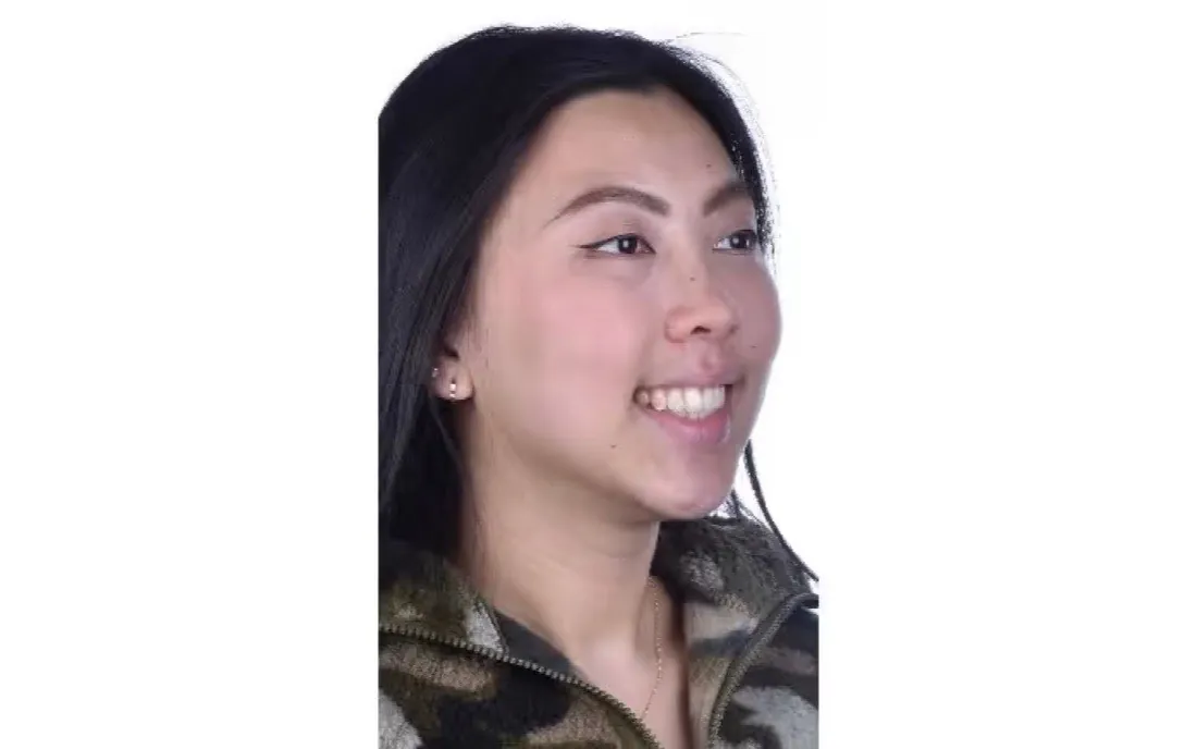 The same patient’s teeth after braces treatment