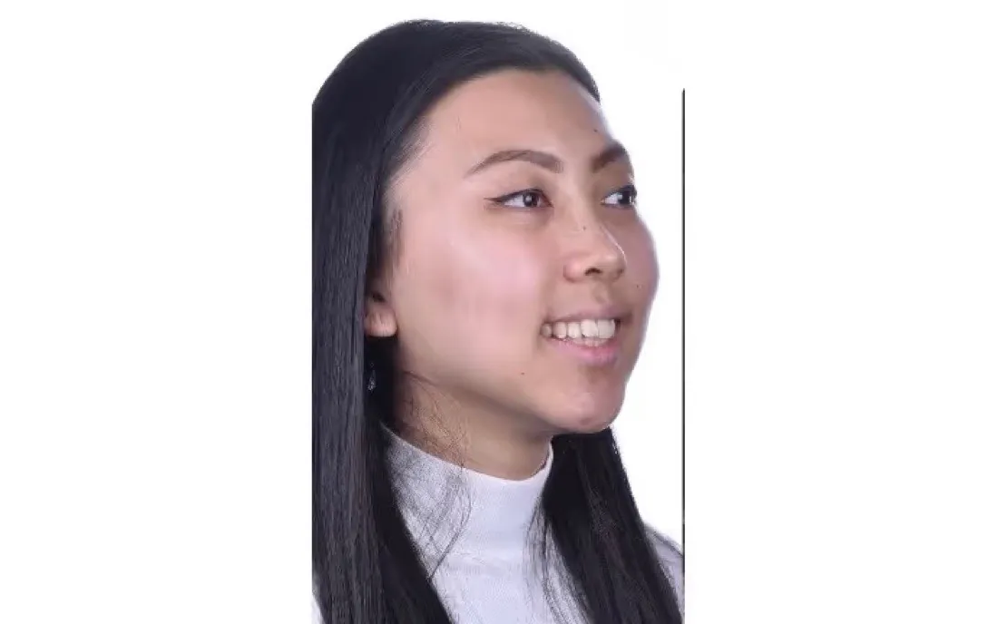 A patient’s teeth before braces treatment