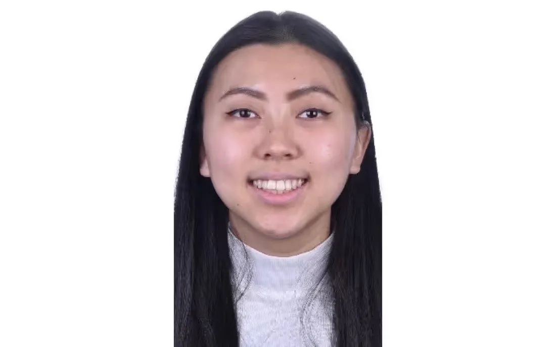 A patient’s teeth before braces treatment