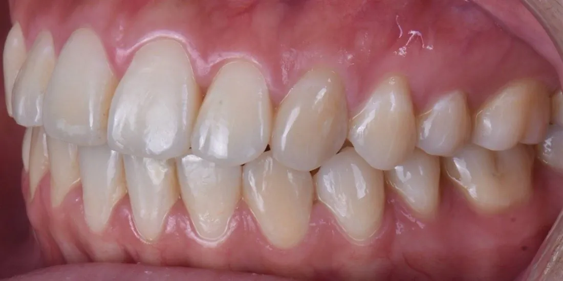 The same patient’s teeth after braces treatment