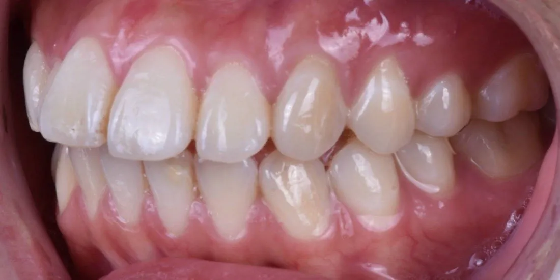 A patient’s teeth before braces treatment
