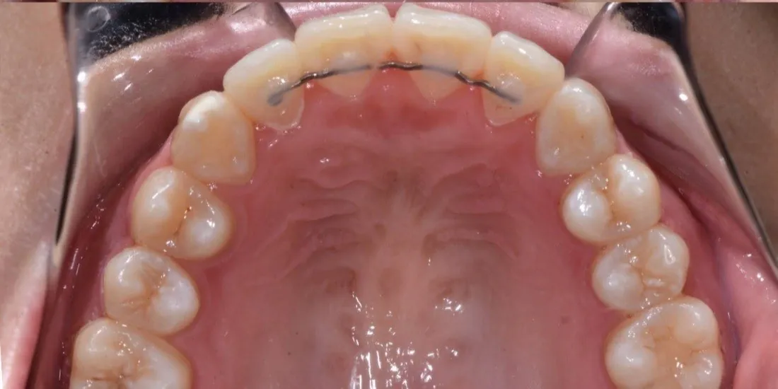 The same patient’s teeth after braces treatment