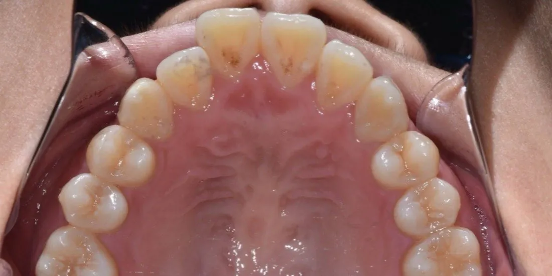 A patient’s teeth before braces treatment