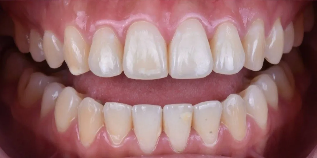 The same patient’s teeth after braces treatment
