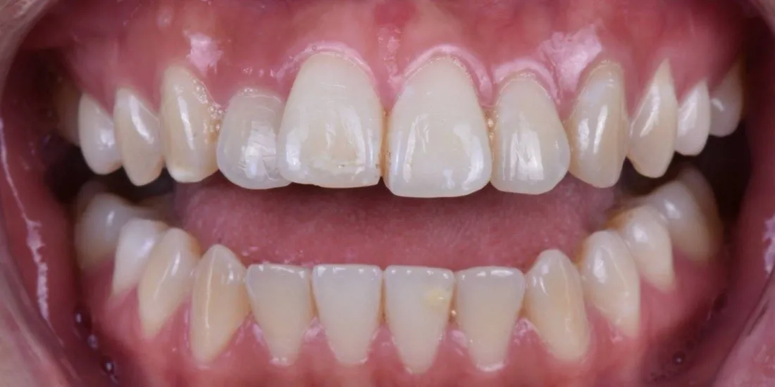 A patient’s teeth before braces treatment