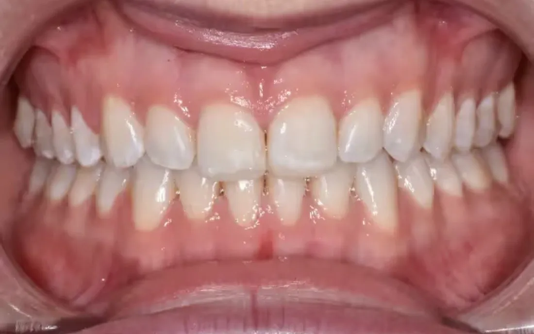 The same teeth after the braces were removed, meeting evenly across both arches