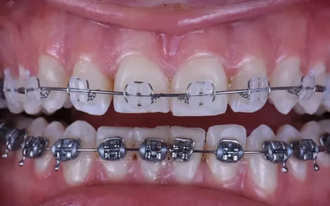 A close view of the same teeth partway through treatment, with brackets and archwires on both arches