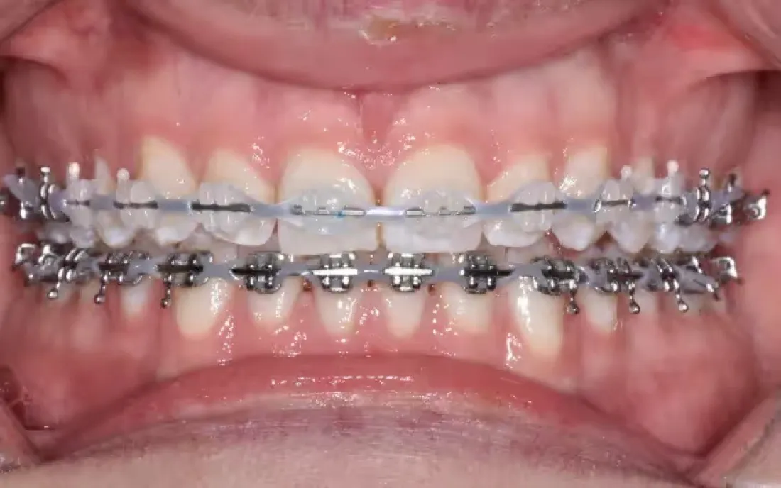 The same teeth with clear brackets on the upper arch and metal brackets on the lower arch