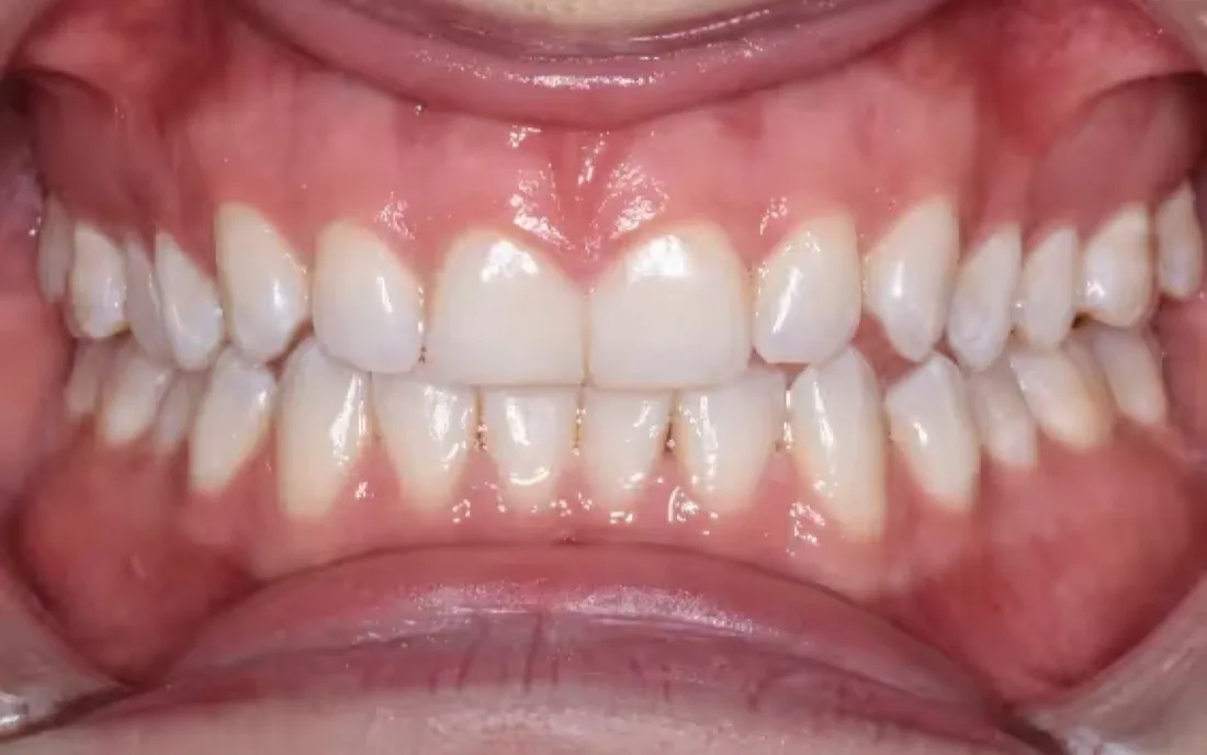 A close view of the upper and lower teeth before braces were placed