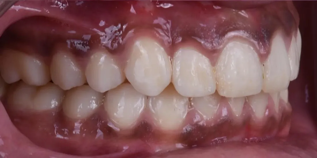 The same side view after braces, with the canine in line with the neighbouring teeth