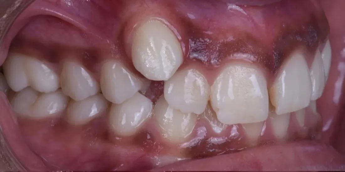 A side view of a patient’s teeth before braces, with an upper canine sitting high and out of the arch