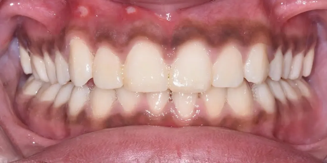 The same front view after braces, with the teeth aligned and meeting evenly