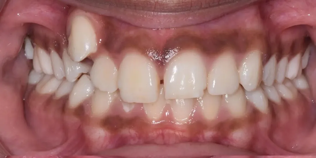 A front view of a patient’s teeth before braces, with an upper canine erupted above the arch and crowding across the front teeth