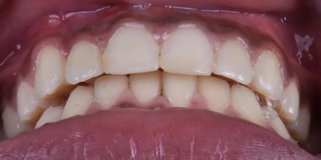 The same front view after braces, with the upper front teeth level and evenly spaced