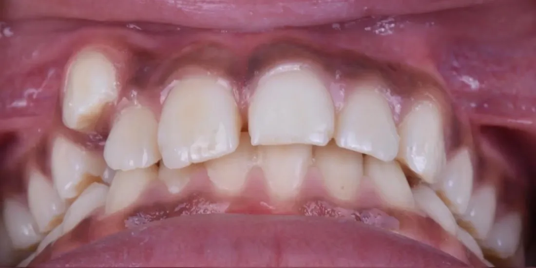 A front view of a patient’s teeth before braces, with the upper front teeth overlapping and rotated