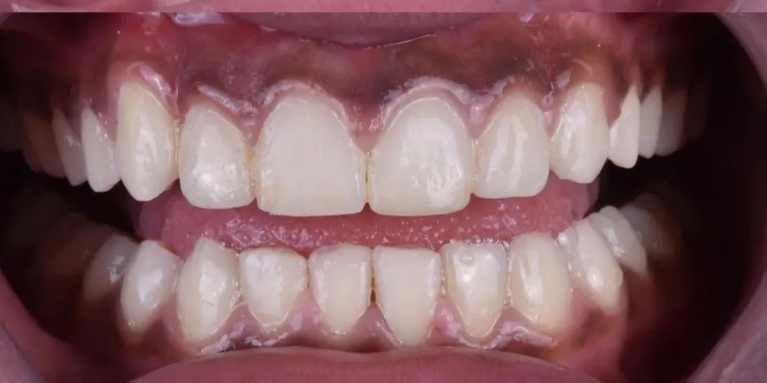 The same front view after braces, with the gap closed and the arch aligned