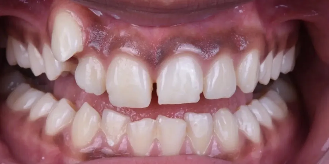A front view of a patient’s teeth before braces, with a gap between the two upper front teeth