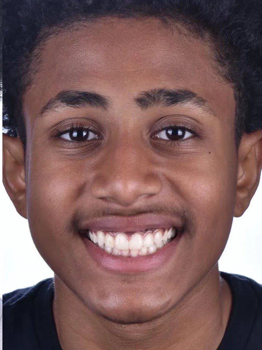 The same patient smiling to camera after braces, with an even upper arch