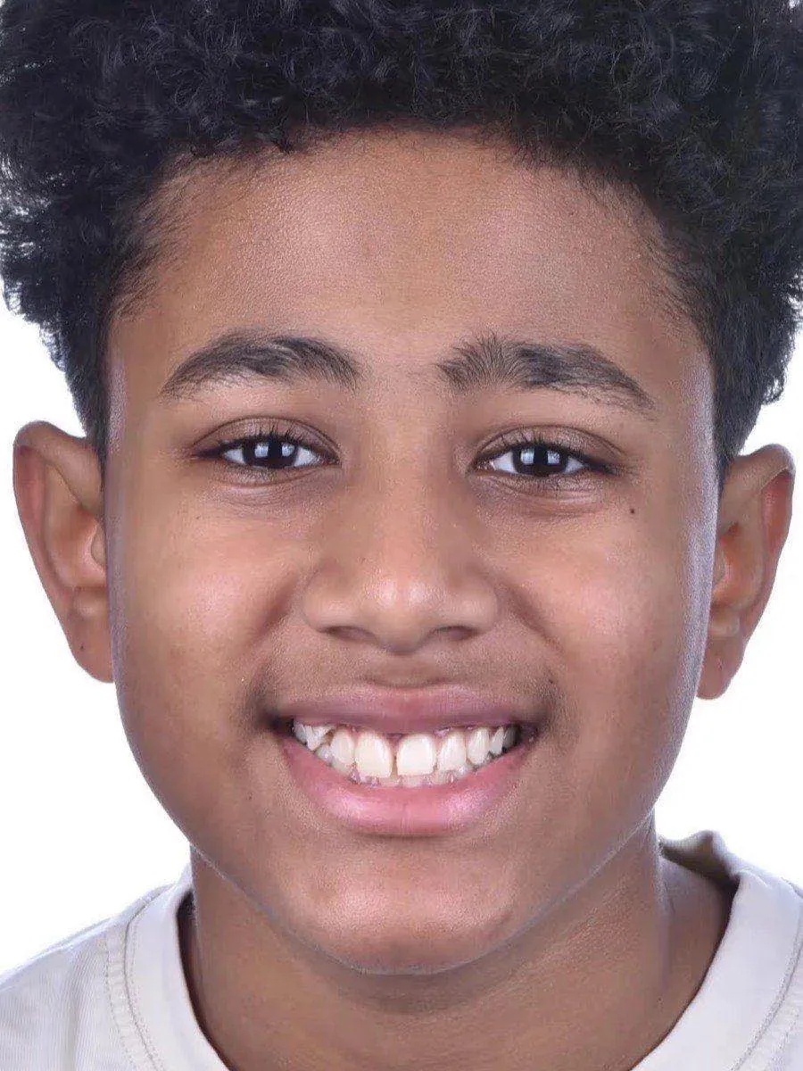 A young patient smiling to camera before braces, with a gap between the upper front teeth