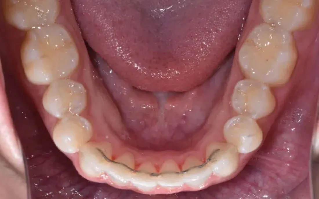 The same patient’s teeth after treatment with C5 Hidden Orthodontics