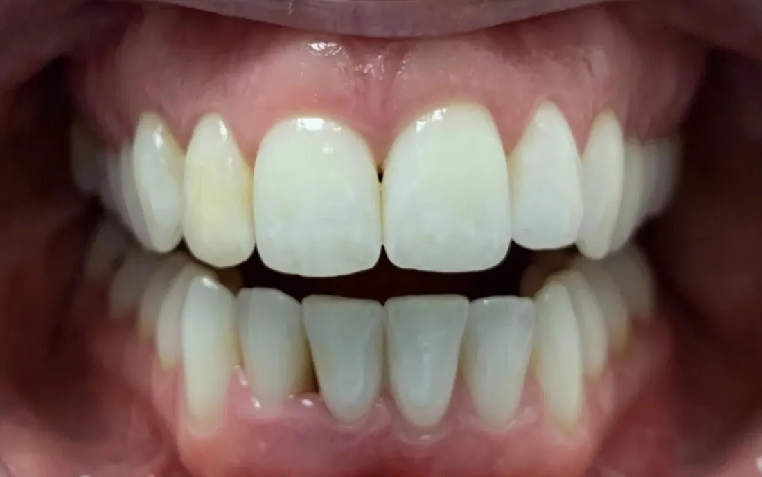 The same patient’s teeth after treatment with C5 Hidden Orthodontics