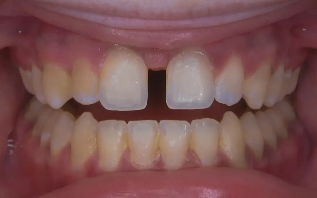 A patient’s teeth before treatment with C5 Hidden Orthodontics