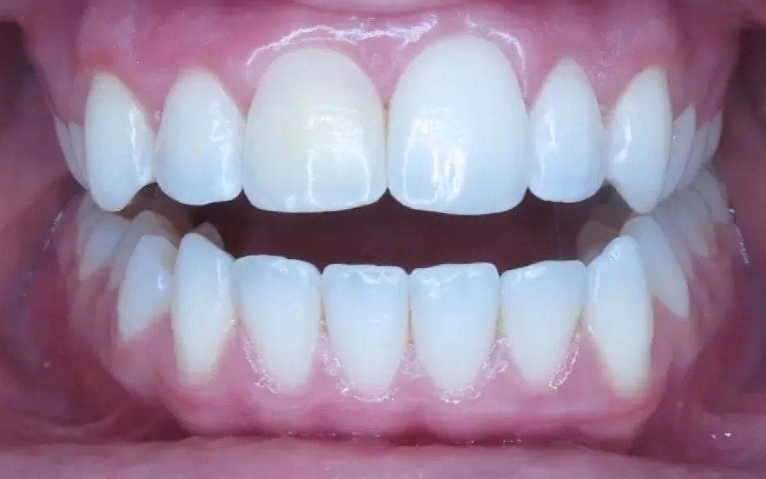 The same patient’s teeth after treatment with C5 Hidden Orthodontics