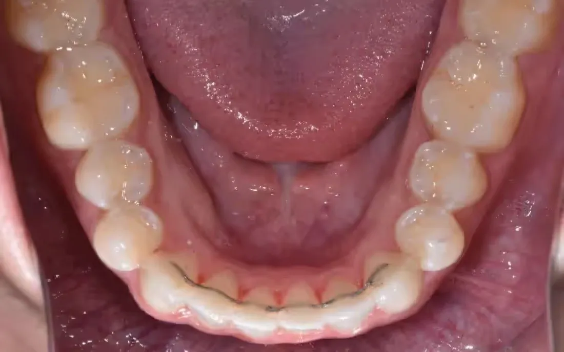 The same view after treatment, the front teeth aligned and a thin bonded retainer wire behind them