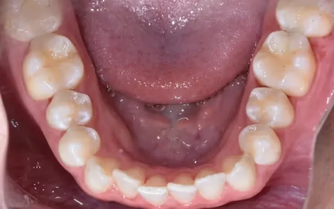A view down onto the lower teeth before treatment, with the front teeth overlapping