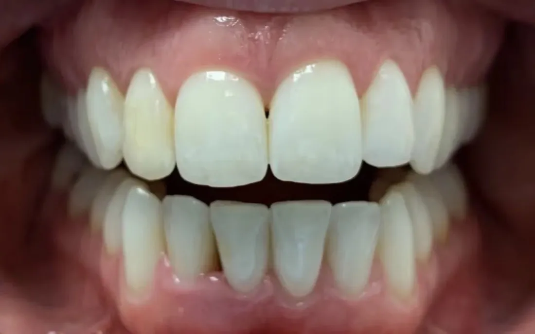 The same front view after treatment, with the upper teeth level and evenly spaced