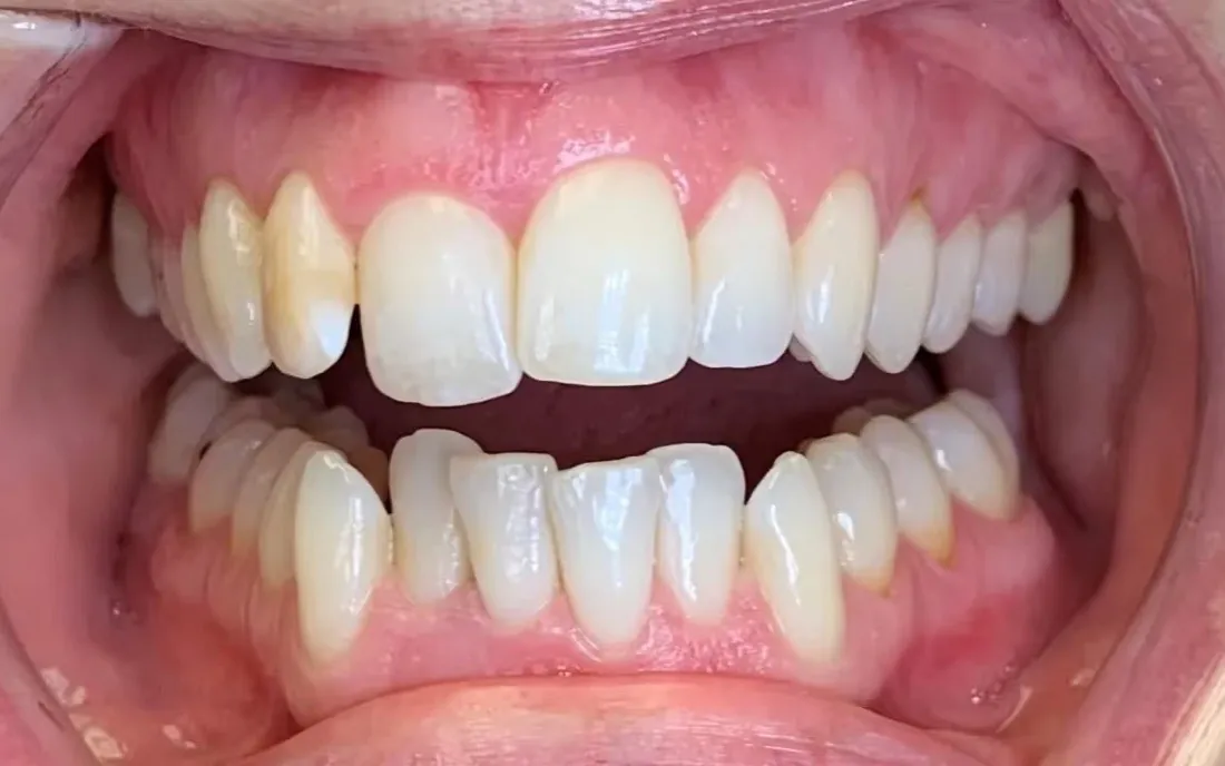 A front view of the teeth before treatment, with an upper tooth rotated and sitting out of line
