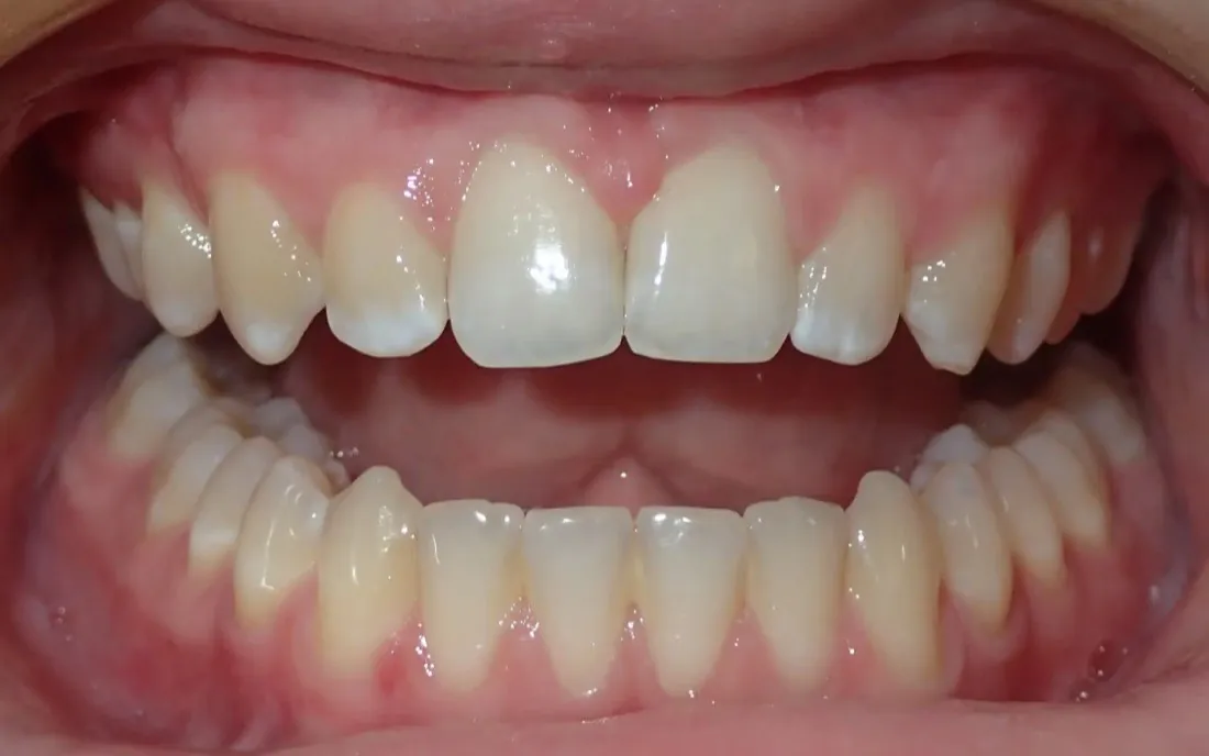 The same front view after treatment, with the gap closed