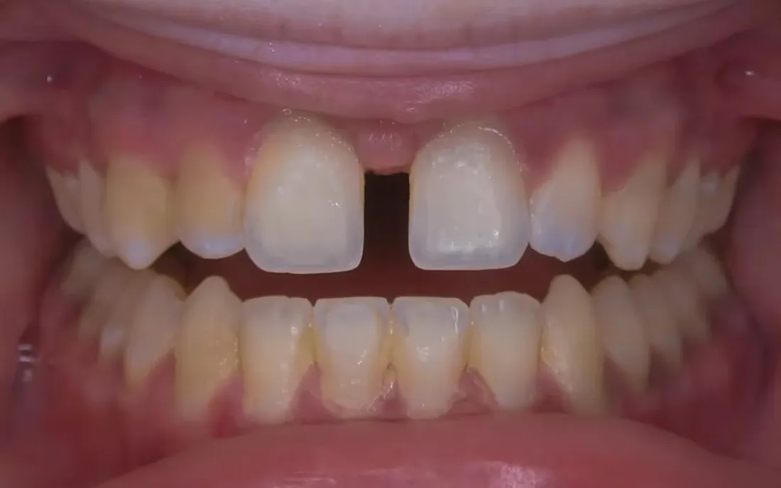 A front view of the teeth before treatment, with a gap between the two upper front teeth