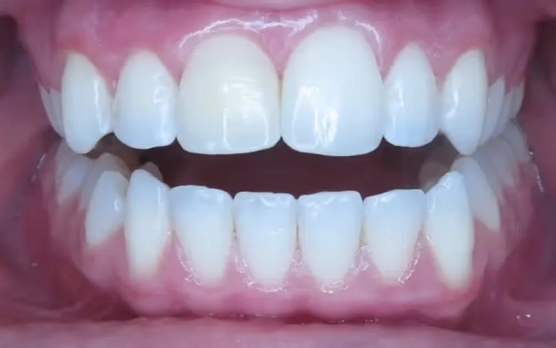 The same front view after treatment, with the upper front teeth in an even arch