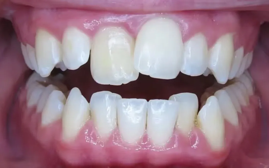 A front view of the teeth before treatment, with an upper front tooth turned and standing forward of the others