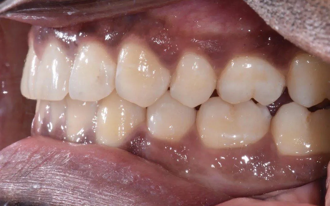The same patient’s teeth after clear aligner treatment