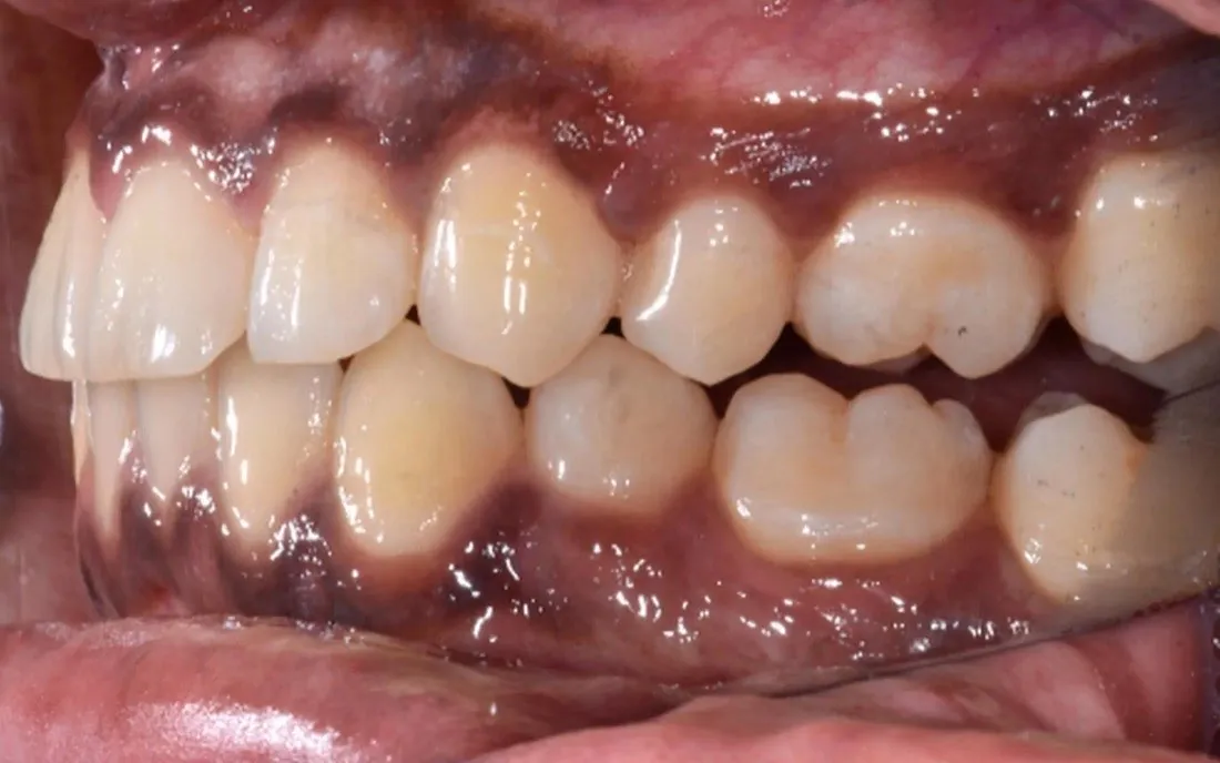A patient’s teeth before clear aligner treatment