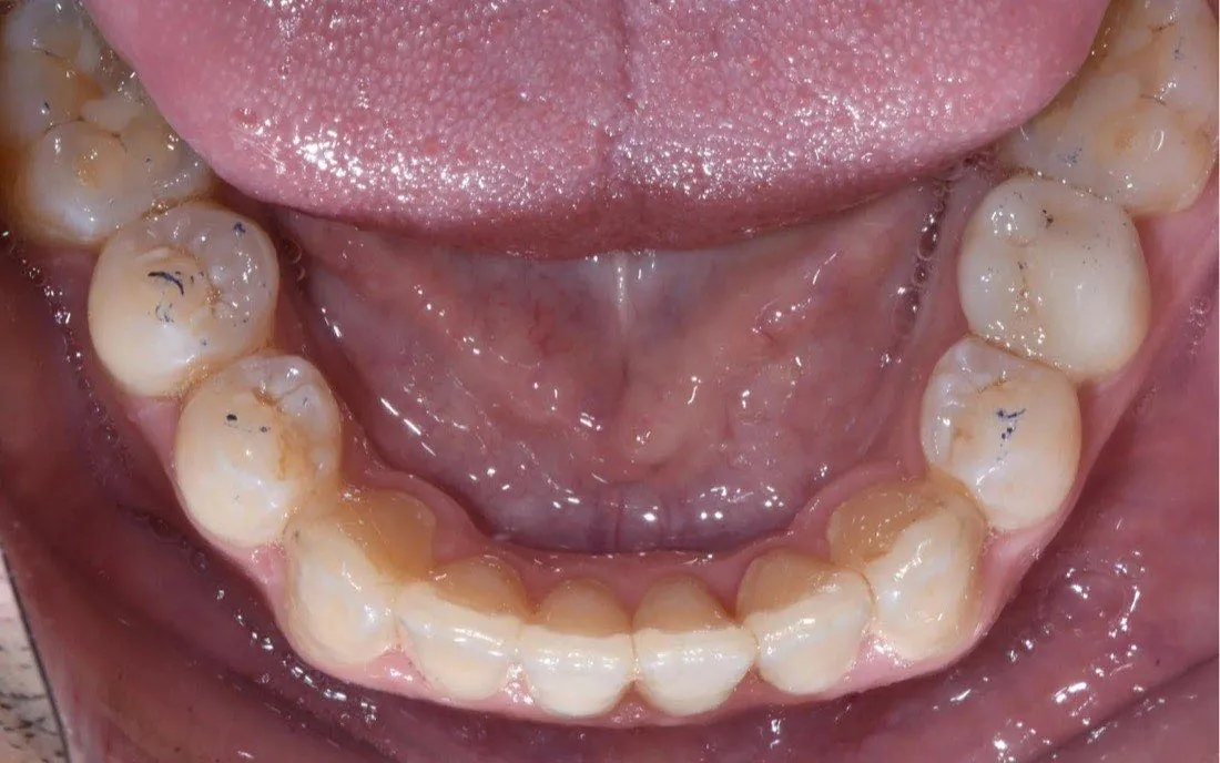 The same patient’s teeth after clear aligner treatment