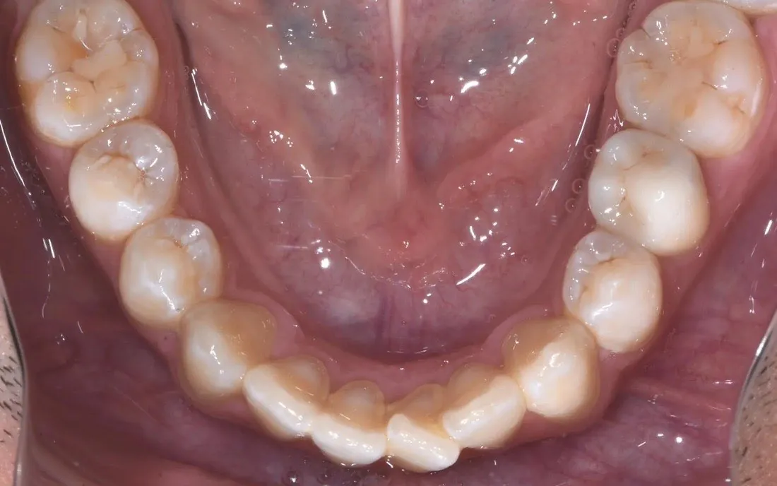 A patient’s teeth before clear aligner treatment
