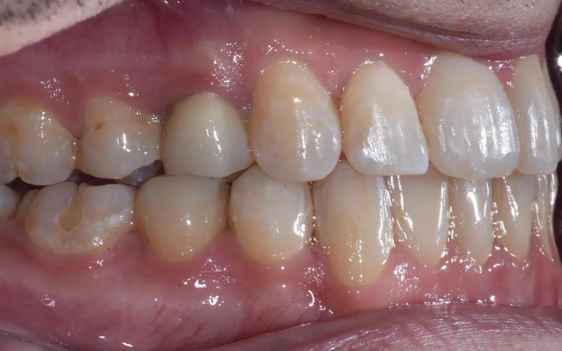 The same patient’s teeth after clear aligner treatment