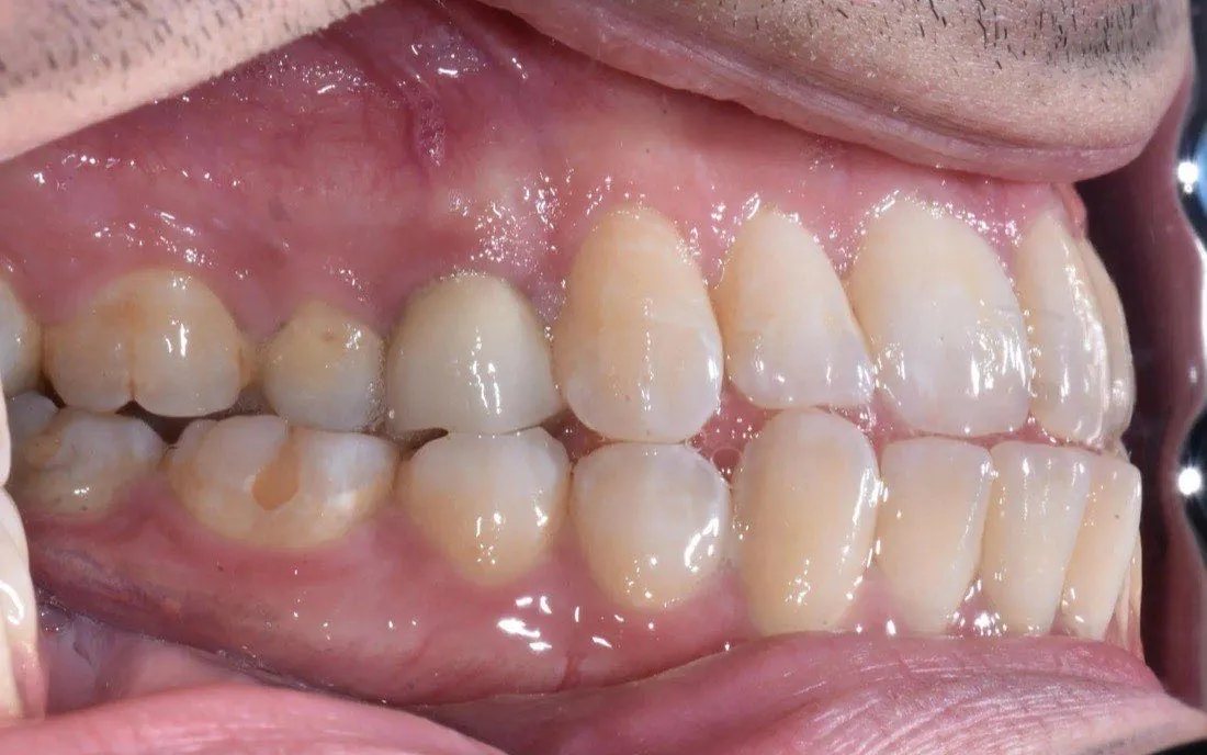 A patient’s teeth before clear aligner treatment