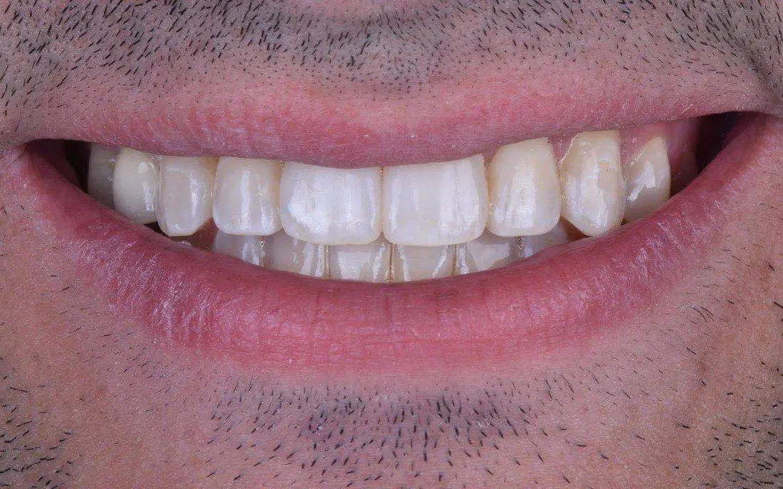 The same patient’s teeth after clear aligner treatment