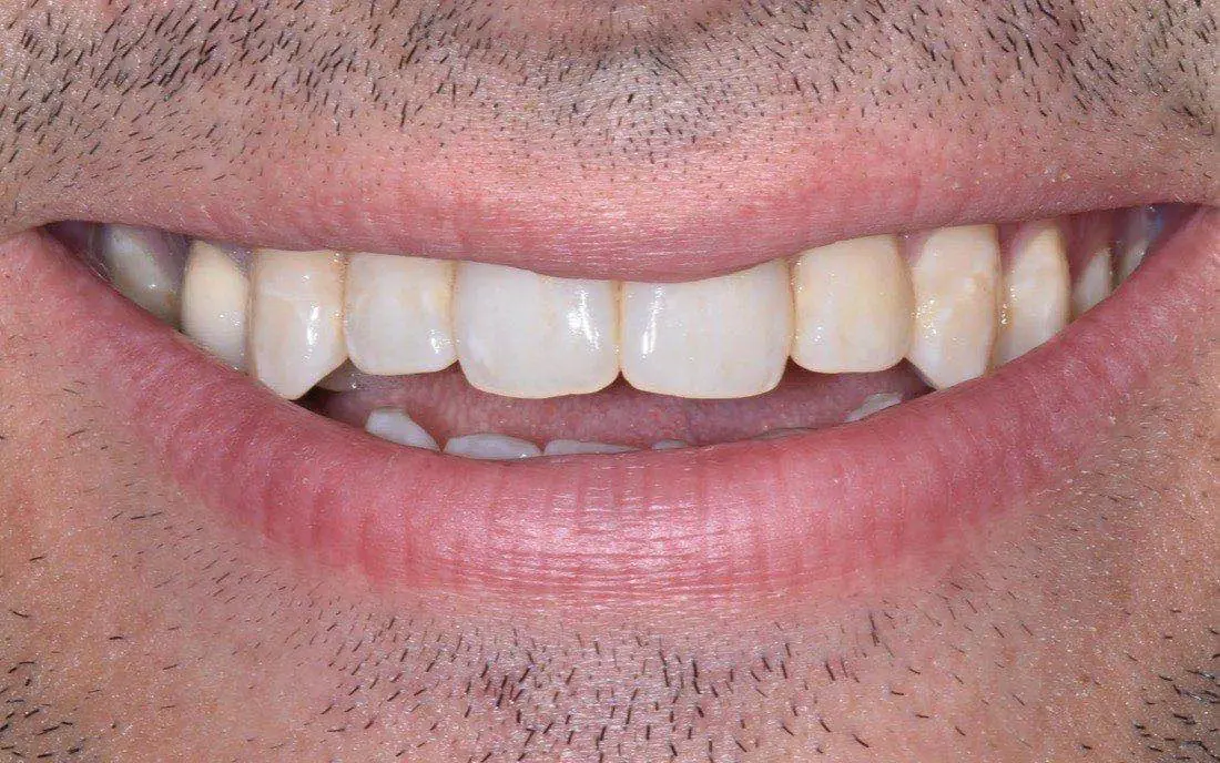 A patient’s teeth before clear aligner treatment